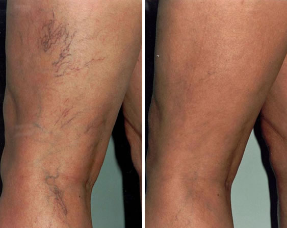 capillari gambe: foto prima e dopo il trattamento laser